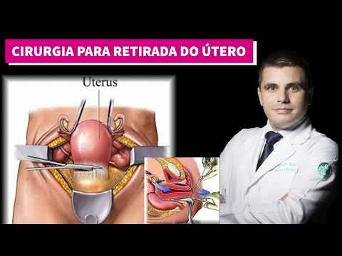 Vídeo: O útero pode ser removido por laparoscopia?