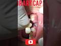 #thedentalviewsTemporary cap fixation #dentist #teeth #dentalclinic #dentalcrownsbeforeafter