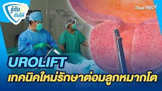 UROLIFT เทคนิคใหม่รักษาต่อมลูกหมากโต | รู้ทันกันได้ | วันใหม่วาไรตี้