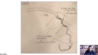 Practice Tips with Dr. Lichaa: Perforated Balloon No Reflow