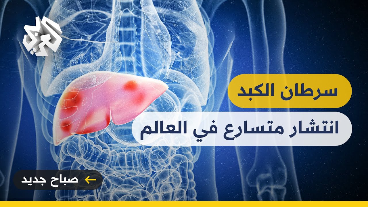 وكالة بحوث السرطان تحذر من انتشار غير مسبوق لسرطان الكبد خلال السنوات القادمة