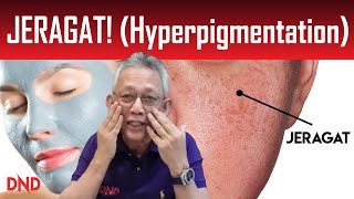 JERAGAT! (hyperpigmentation) APA NAK BUAT!!