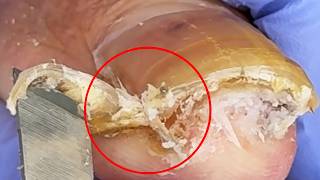 Highlight Curled Ingrown Toenails! Solve Foot Problems【Xue Yidao】