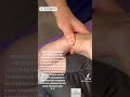 REHABILITACIÓN DE ARTROPLASTIA DE CODO EN UNA SESIÓN.