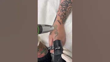إزالة الوشم 