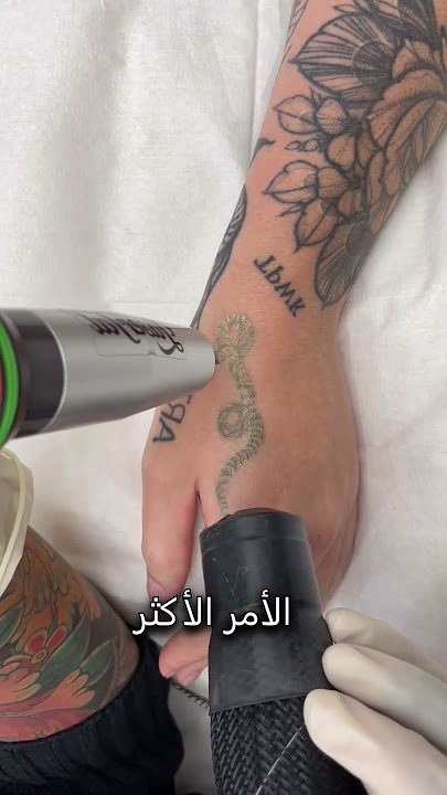 إزالة الوشم