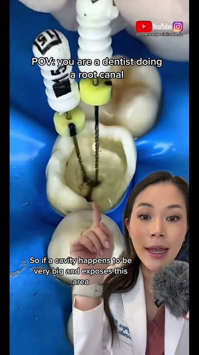 Files for a root canal. #rootcanal #files #cavity #dentist