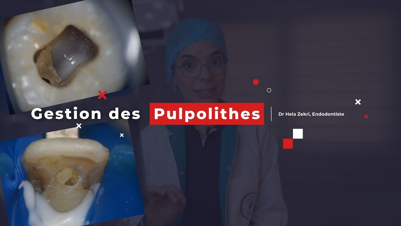 Gestion des pulpolithes