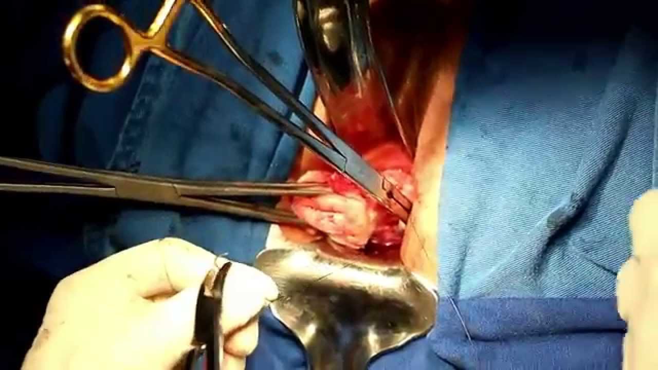 Histerectomia vaginal / vaginal hysterectomy medicinal genomics