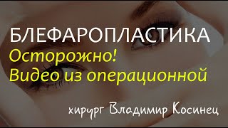 Расширенная блефаропластика с миопексией - хирург Владимир Косинец