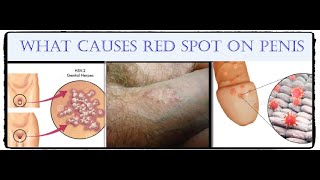 What Red Spots on the Penis and How Are Treated.البقع الحمراء على القصيب السبب والعلاج - YouTube