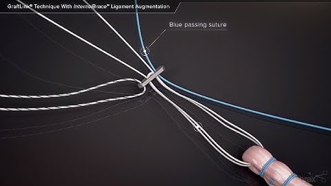 GraftLink® Technique With InternalBrace™ Ligament Augmentation