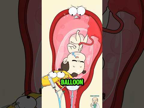 Video The Secret Balloon Tool For Induction