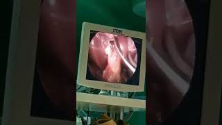 استئصال المراره بالمنظار cholécystectomie coelio #laparoscopicsurgeon