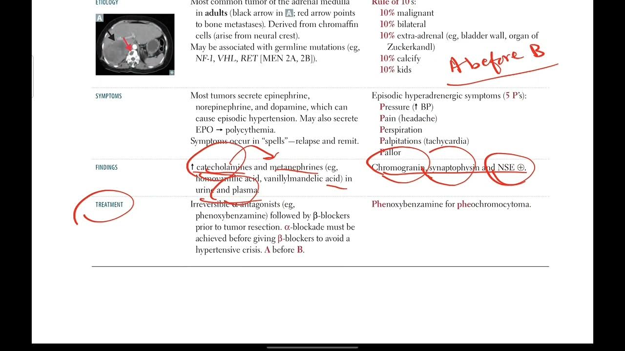 Pheochromocytoma Endocrinology 21 First Aid In Urdu Hindi YouTube pheochromocytoma-endocrinology-21-first-aid-in-urdu-hindi-youtube