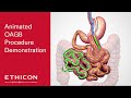 One Anastomosis Gastric Bypass (OAGB) Animated Patient Education Video | Ethicon