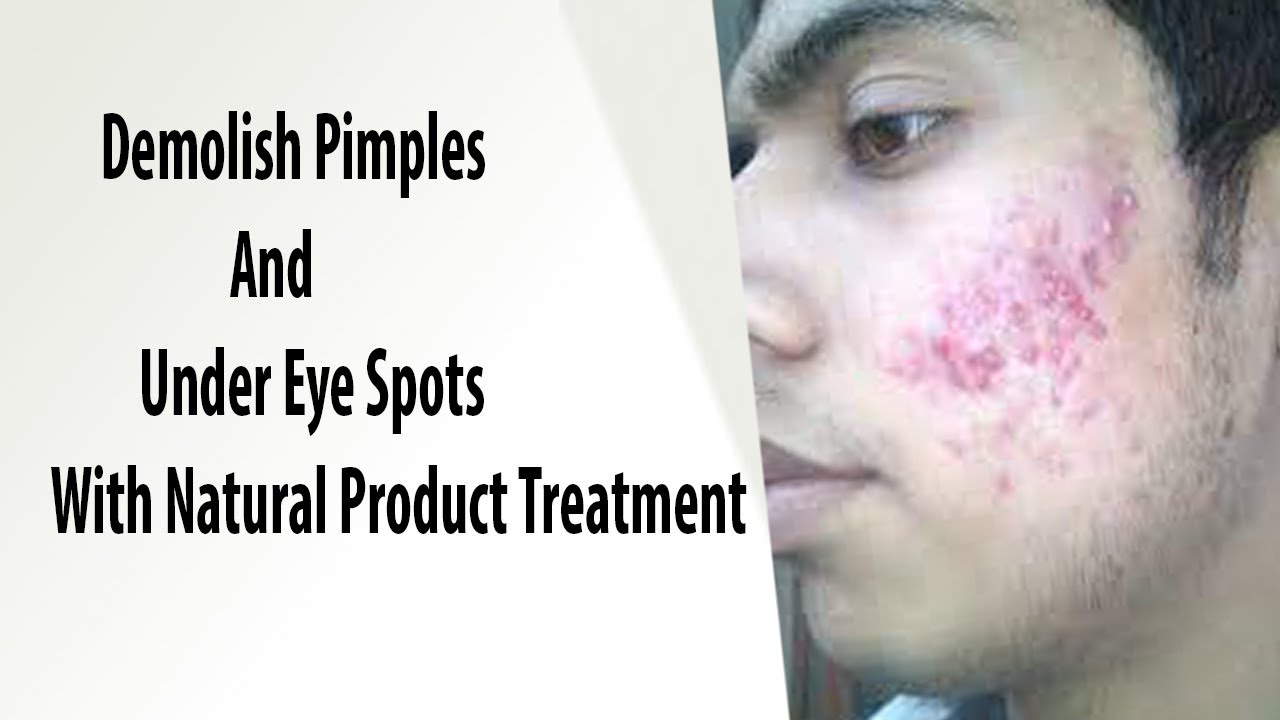 Get Pimples removal face wash Black spots and Dark Circles on face