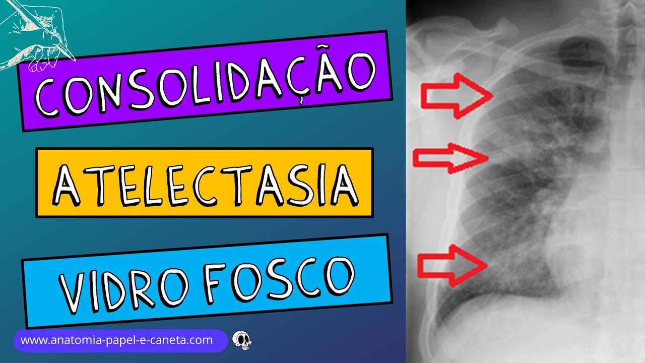 Consolidação Pulmonar Raio X - RETOEDU