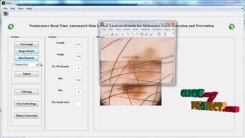 Noninvasive Real-Time Automated Skin Lesion Analysis  for Melanoma Early Detection and Prevention