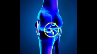 PCL or Posterior Cruciate Ligament Injury: How to detect and treat them-Explained by Dr. Pradyumna R