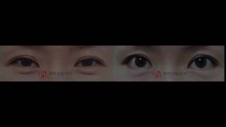 korea plastic surgery before and after epicanthoplasty, lateralcanthoplasty