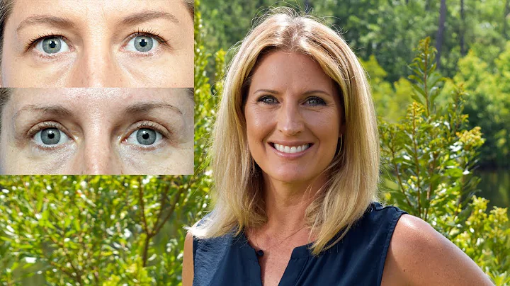 Suzanne's Blepharoplasty Transformation Story