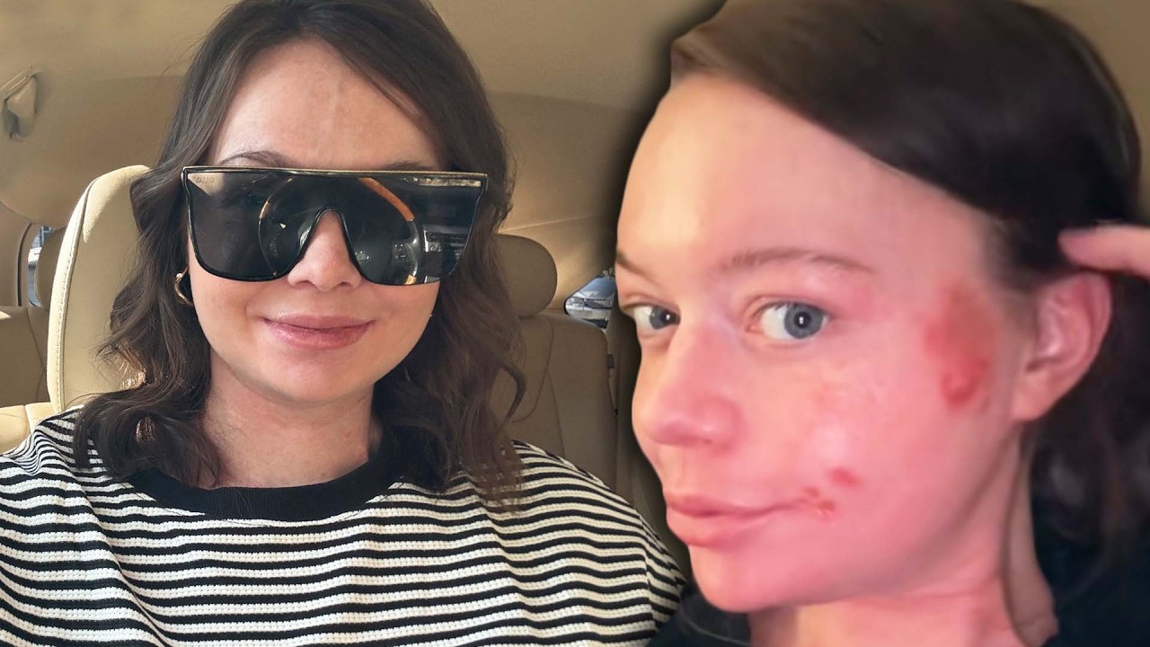 Virginia Woman's Rare Autoimmune Disease Makes Her Allergic To Sun