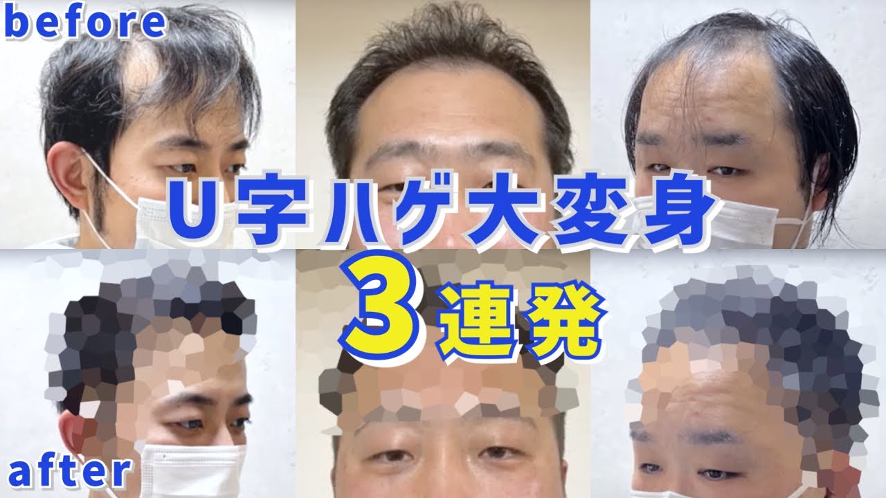 【総集編】これはすごい!薄毛カバー3連発!【U字はげ編】 - YouTube