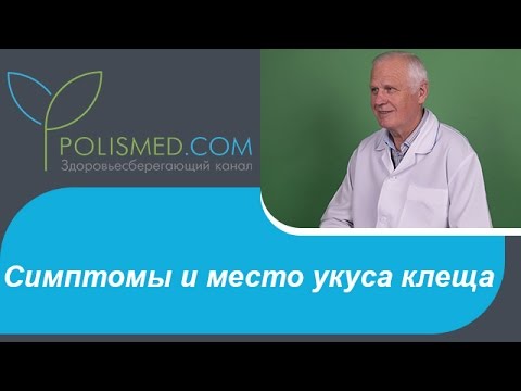 Симптомы и место укуса клеща. Сколько живет клещ после укуса. К какому врачу обращаться