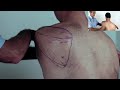 Trigger Point Master Class - How to Release Infraspinatus