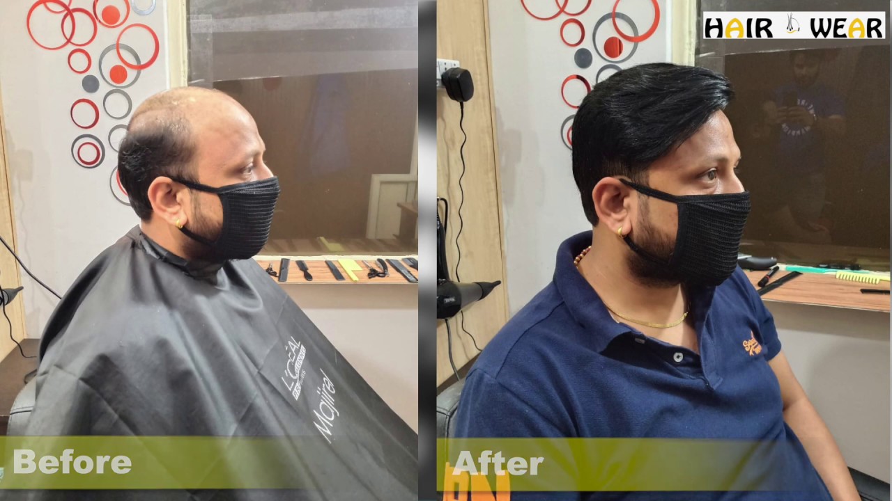 👴Hair Replacement👦 Hair Patch & Wigs in Chandigarh 📞9988765858 🇮🇳 INDIA
