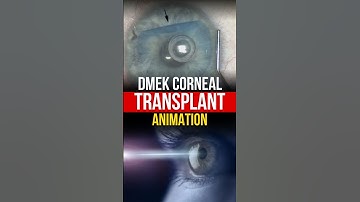 DMEK Corneal Transplant Surgery | Detailed Animated Procedure