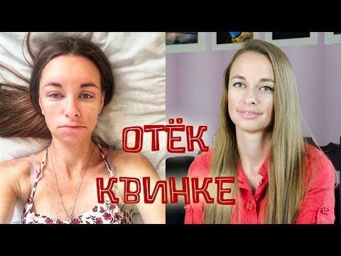 Отёк Квинке и крапивница. Мой печальный опыт