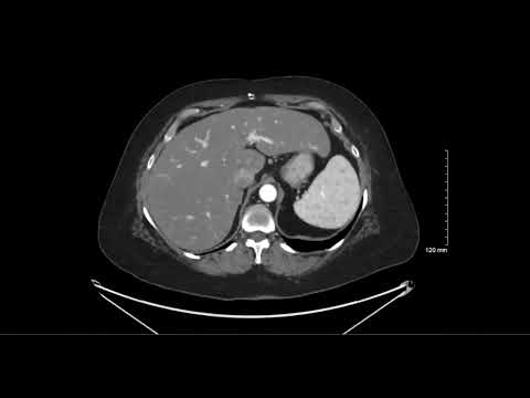 Abdominal Case Conference