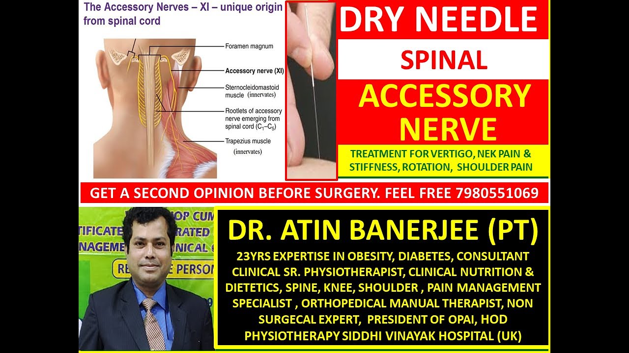 VERTIGO NECK PAIN & STIFFNESS TREATMENT BY DRY NEEDLING ON SPINAL