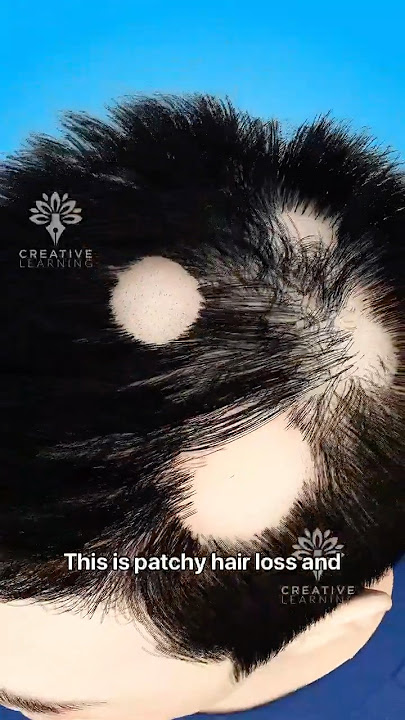 Why Am I Losing Hair in Patches - Explain Alopecia Areata #short #viralvideo - Creativelearning3d