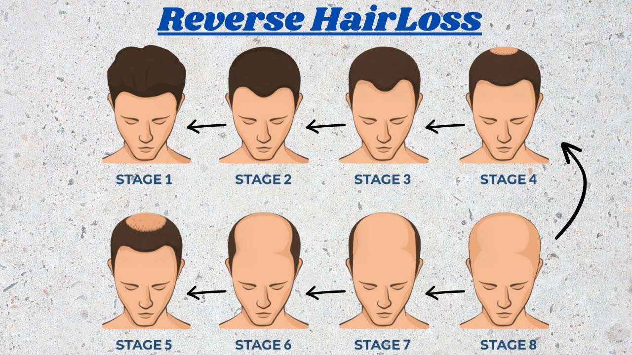 Reverse Hair Loss in 3 min, (no Bs guide) - YouTube