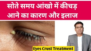 आख म जयद कचड आन क इलज Sleep Crust