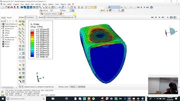 Short Dental Implant Dynamic loading Stress Analysis using ABAQUS
