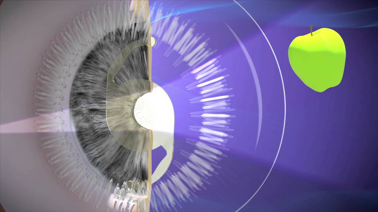 Non Cataract Lens Replacement.mov YouTube