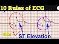 ECG interpretation made easy | Chamberlain's 10 rules of ECG |what is normal ECG Reading,Techhealth