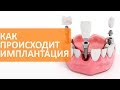 🔵 Основные этапы имплантации зубов | Семейный доктор