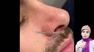 Celebrity Large pores treatment | dr Skinly Profile