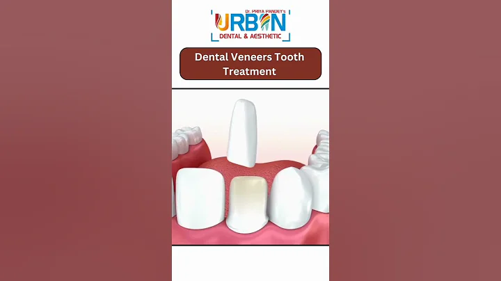 Dental Veneers Tooth Treatment - Dental Care | Urban Dental Clinic #shorts #dentalcare - DayDayNews