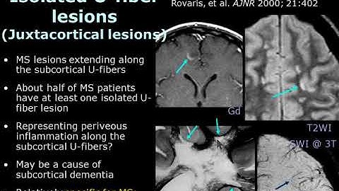 ISMRM MR Academy: Acute Demyelination