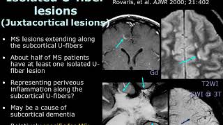 ISMRM MR Academy: Acute Demyelination