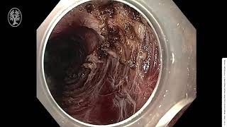 Peroral endoscopic myotomy, septotomy, and restoration of esophageal lumen with over-the-scope clips