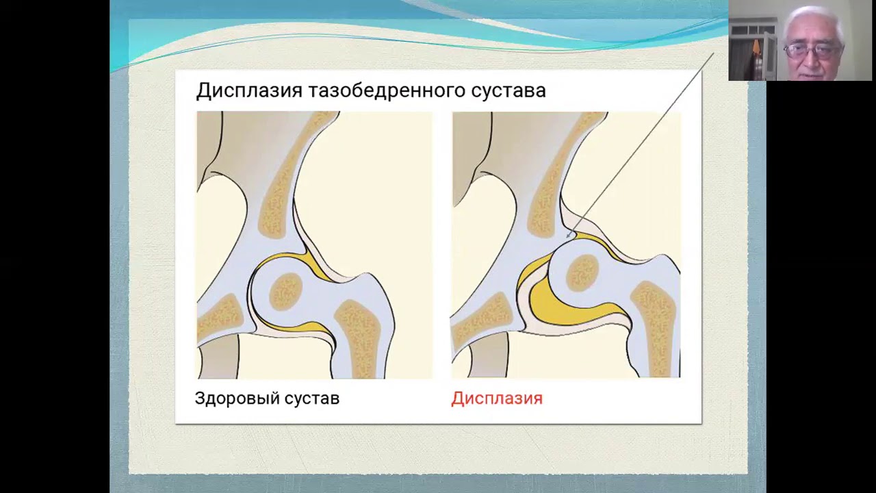 Дисплазия тазобедренного сустава Врожденный вывих бедра - YouTube