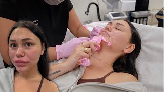 I DISSOLVED ALL THE FILLER IN MY FACE... then this happened