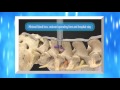 Vertiflex Superion Interspinous Spacer: Lumbar Spinal Stenosis Cured